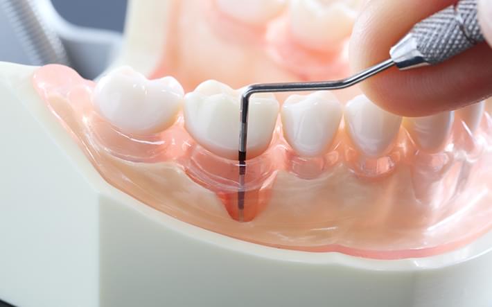 歯周病の治療ステップ